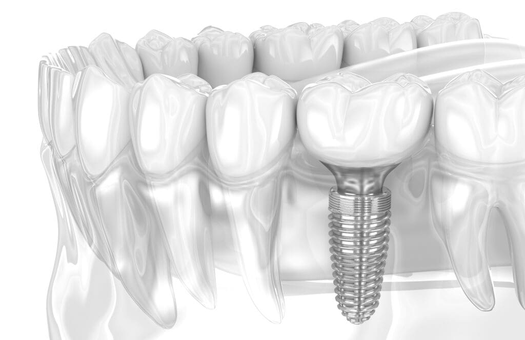 Dental Implant and ceramic crown. 3D illustration of human teeth