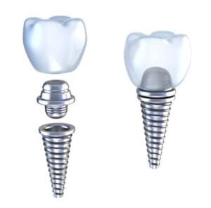 Dr. Jenson offers affordable dental implants
