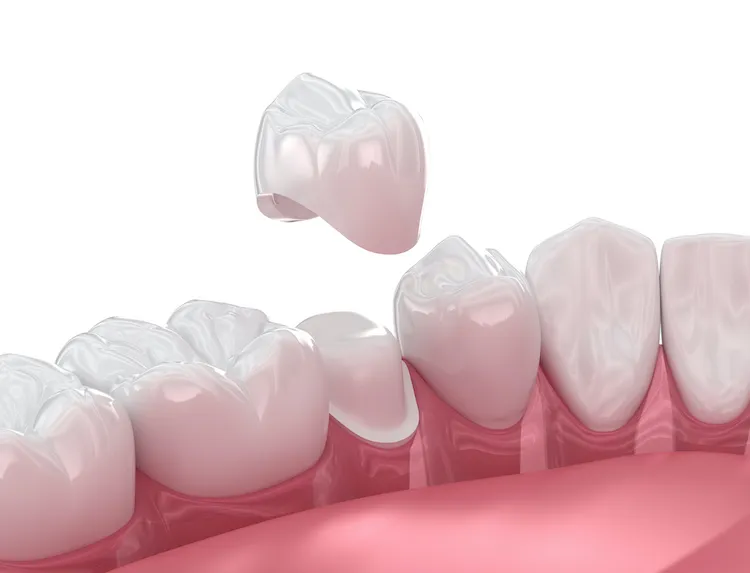 Aftercare for a Dental Crown in Vancouver, WA