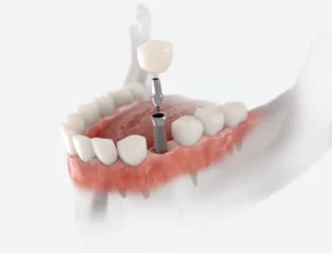 5 Questions About Dental Implants Answered in Vancouver, WA