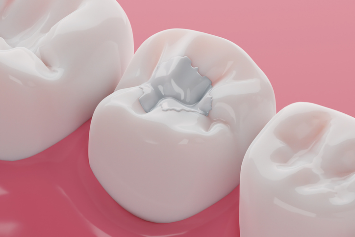 white dental filling or composite filling in Vancouver, WA